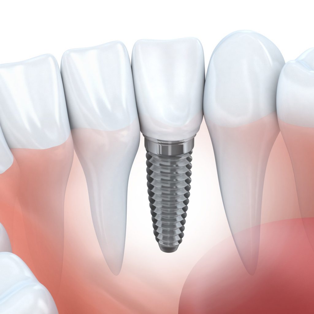 Why choose dental implants?