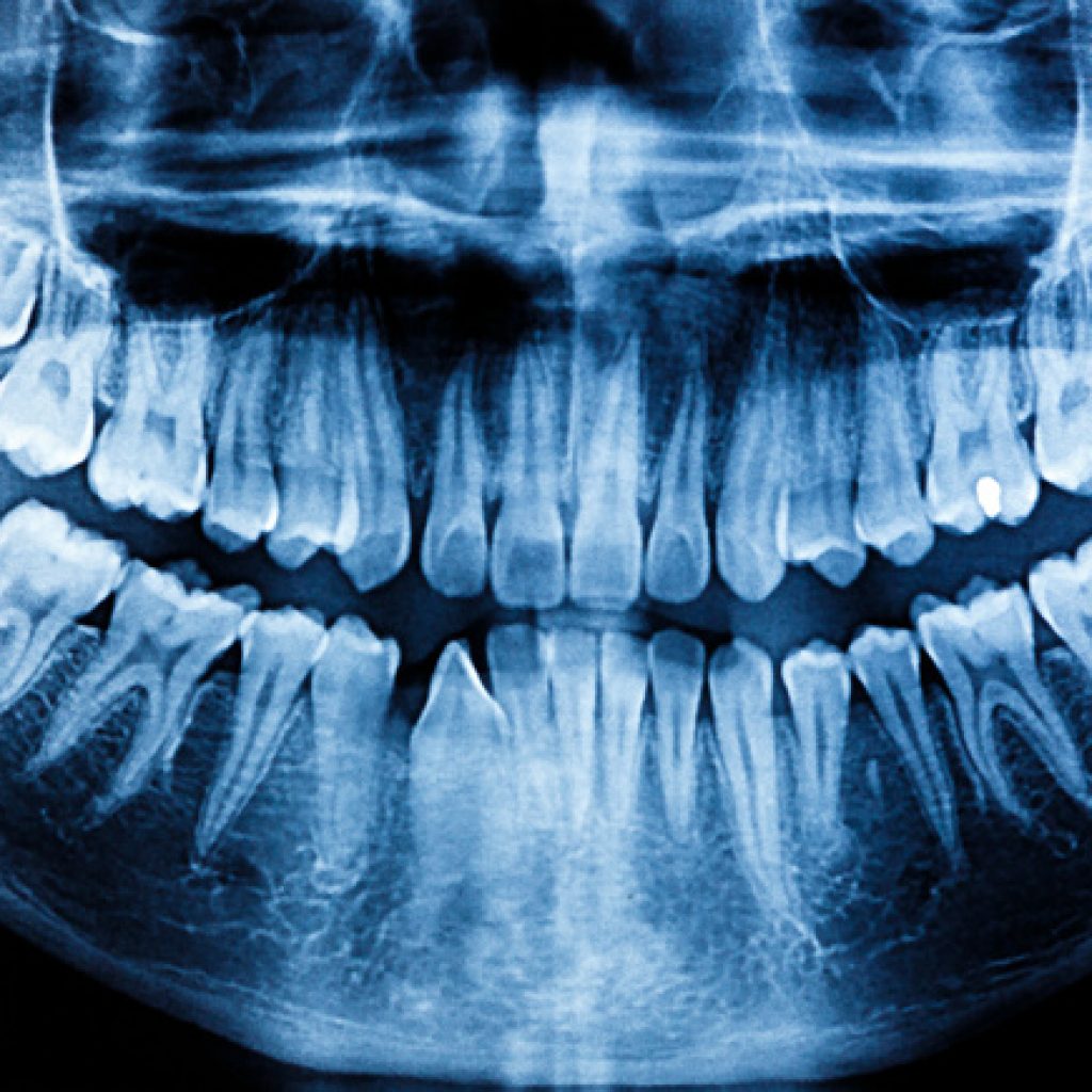 Do I need to have dental X-rays? All your questions answered