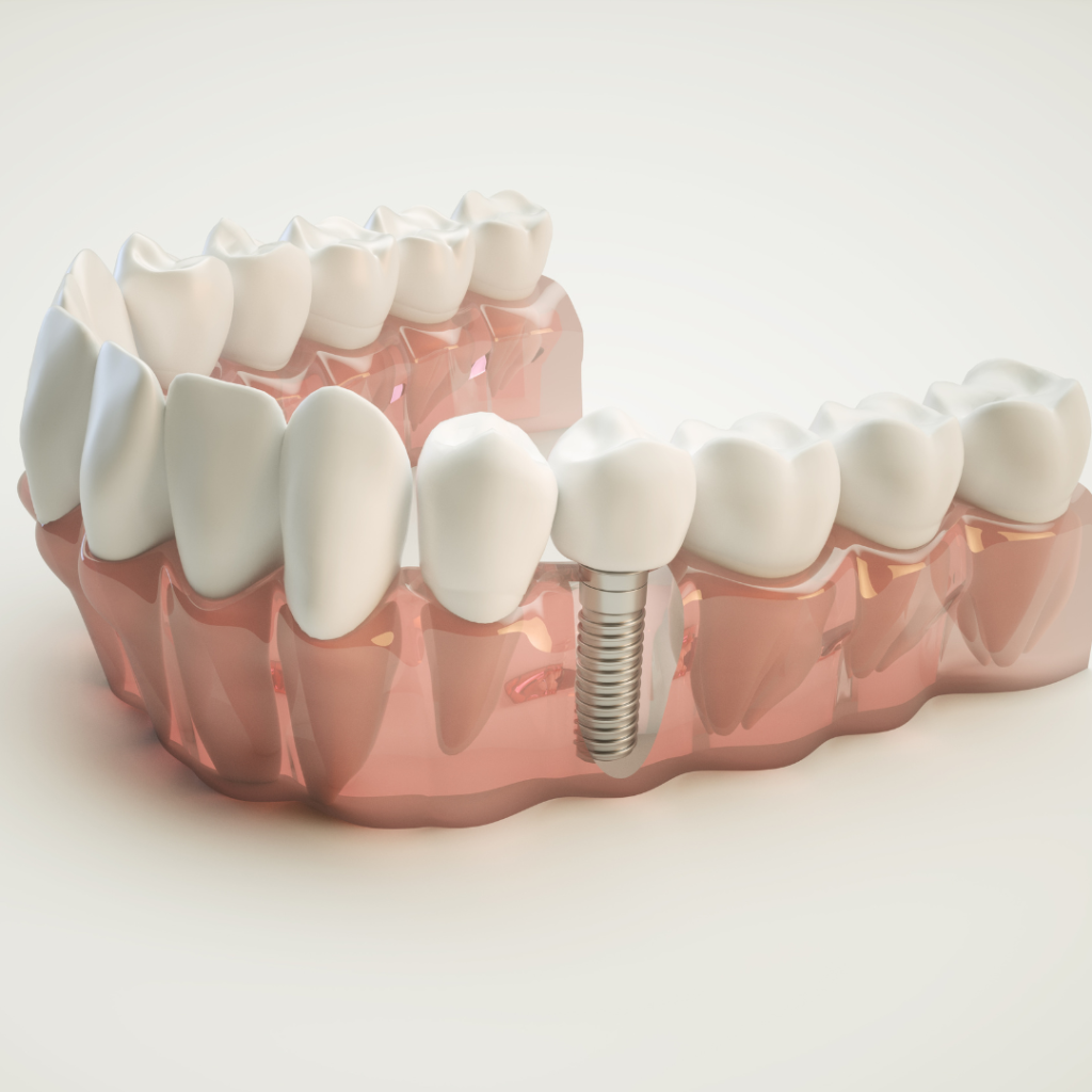 Your guide to dental implant maintenance & care