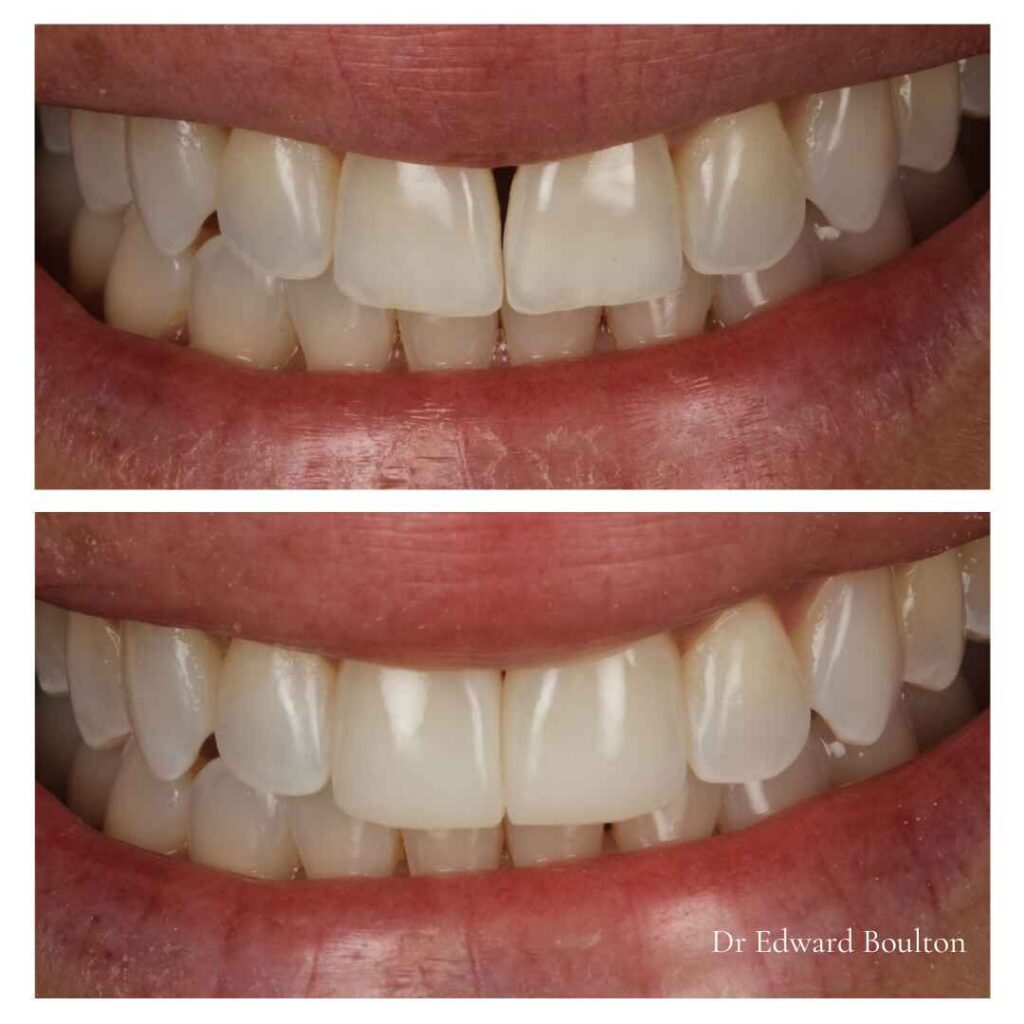 Veneers